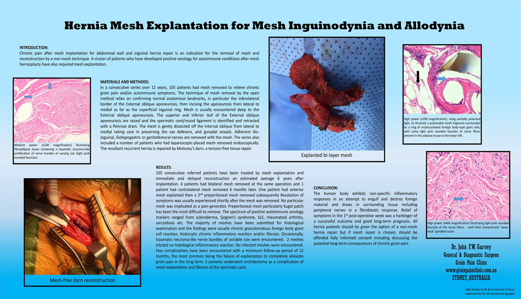 Henia Mesh Explantation for Mesh Inguinodynia and Allodynia